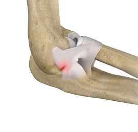 Lateral Ulnar Collateral Ligament Injuries Elbow