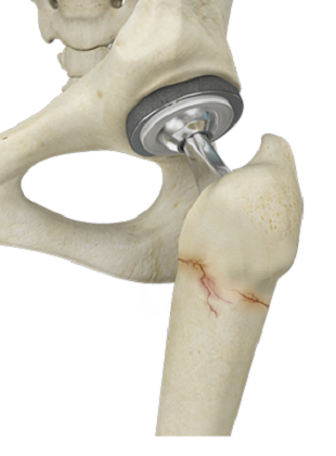 Periprosthetic Shoulder Fracture Fixation