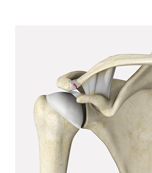 AC Joint Separation Salem, OR  Shoulder Joint Separation