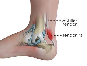 Achillles Tendinitis