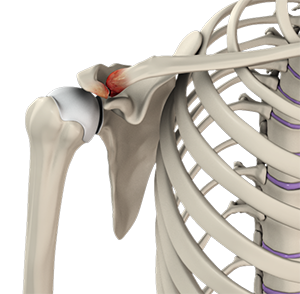 Acromioclavicular (AC) Joint Osteoarthritis