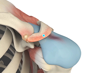 Arthroscopic Acromioplasty