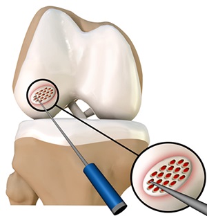 Arthroscopic Debridement