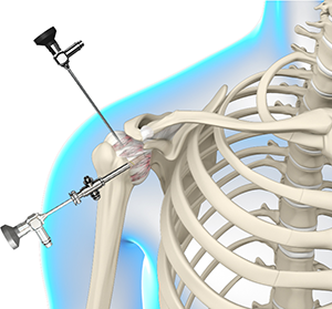 Arthroscopic Frozen Shoulder Release