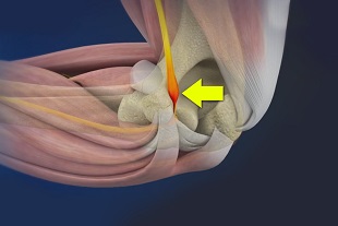 Cubital Tunnel Syndrome Salem, OR  Medial Epicondylectomy Corvallis, OR