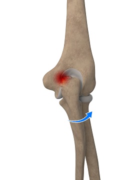 Elbow Impingement