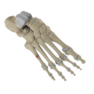 Fifth Metatarsal Fractures