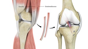 Hamstring Autograft