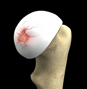 Hip Cartilage Repair