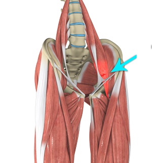 Hip Flexor Strain Eugene, OR  Minor Stretch Injury Salem, OR