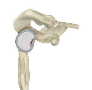 Hip Labral Repair