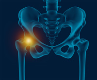 What is hip bursitis? – Midwest Center for Joint Replacement