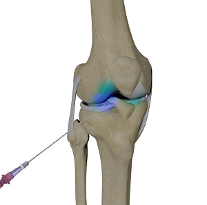 Intraarticluar Knee Injection
