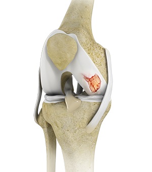 Knee Cartilage Restoration