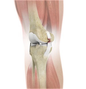 Knee Ligament Reconstruction