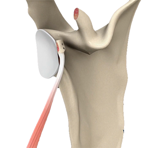 Latarjet Procedure