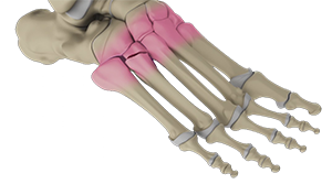 Lisfranc (Midfoot) Fracture