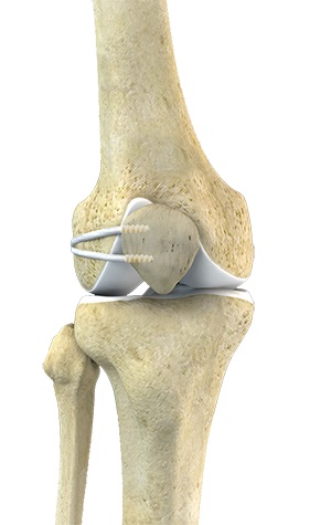 LPFL Reconstruction