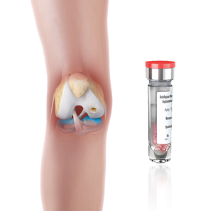 Matrix-Induced Autologous Chondrocyte Implantation