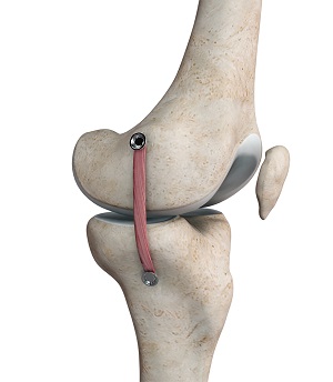 MCL Reconstruction