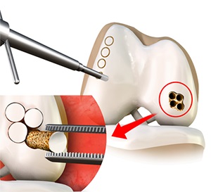 Mosaicplasty