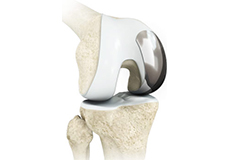 Partial Knee Resurfacing<
