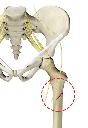 Pediatric Femur Fracture