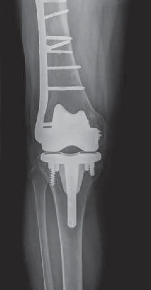 Periprosthetic Knee Fracture Fixation