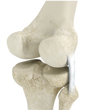 Posterolateral Corner Reconstruction