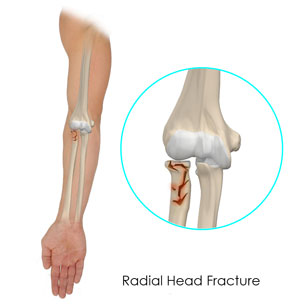 Radial Head Fractures of the Elbow