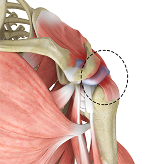 Rotator Cuff Pain