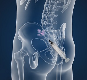 Sacroiliac Joint Injections