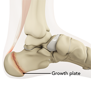 Sever's Disease