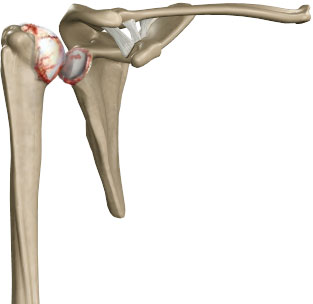 Arthritis of the Shoulder