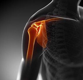 Bicep Tendon Rupture at Shoulder