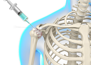 Shoulder Hydrodilatation