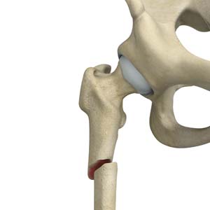 Subtrochanteric Hip Fracture