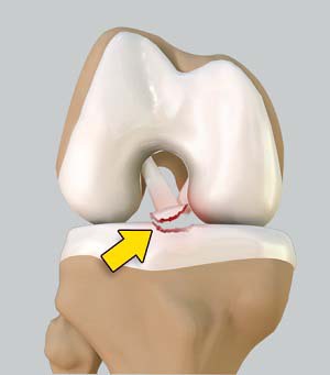 Tibial Eminence Fracture