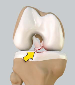 Tibial Eminence Spine Avulsion Fracture