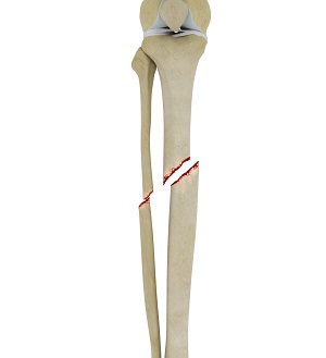 Tibial Shaft Fracture