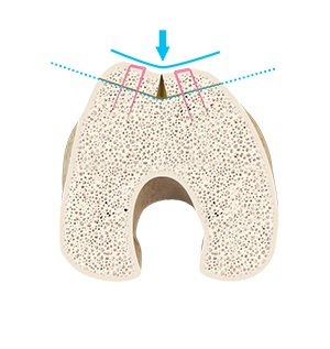 Trochleoplasty